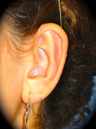 Otoplasty 837165