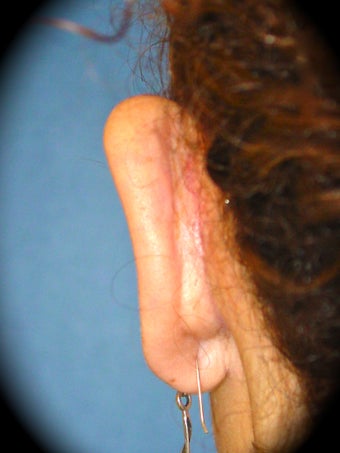 Otoplasty after 837165