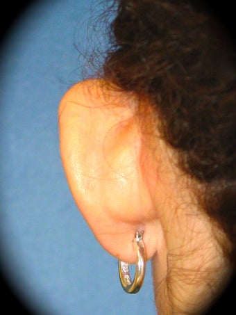 Otoplasty before 837165