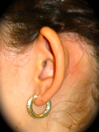 Otoplasty 837165