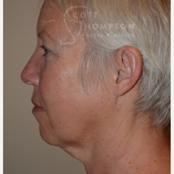 55-64 year old woman treated with Facelift before 3399084