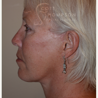 55-64 year old woman treated with Facelift after 3399084