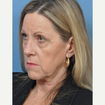 55-64 year old woman treated with Facelift before 3127936
