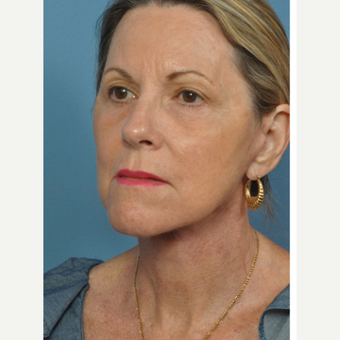 55-64 year old woman treated with Facelift after 3127936