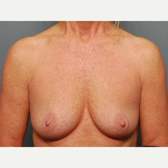49 y/o Inframammary Sub Muscular Breast Augmentation before 3066040