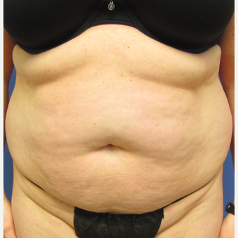 35-44 year old woman treated with Tummy Tuck & Liposuction before 3082692