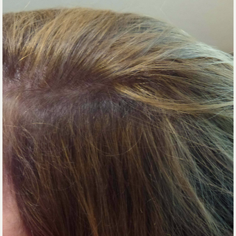 45-54 year old woman treated with PRP for Hair Loss after 2830797