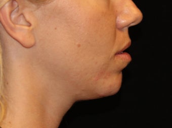 25-34 year old woman treated with Voluma 3503028