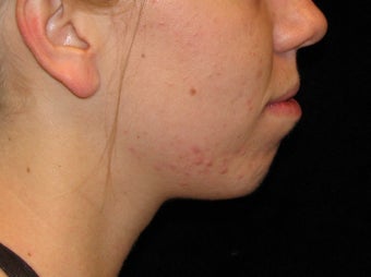 25-34 year old woman treated with Voluma 3503028