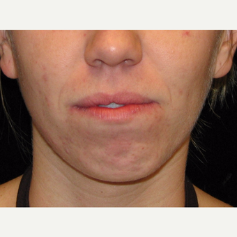 25-34 year old woman treated with Voluma before 3503028