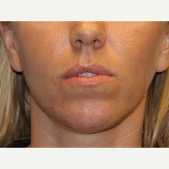 25-34 year old woman treated with Voluma after 3503028