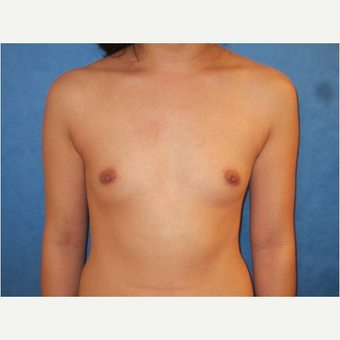 23 year old woman treated with Breast Augmentation before 3725729