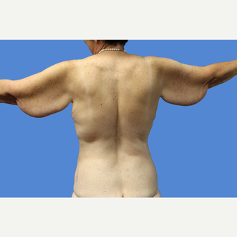 55-64 year old woman treated with Arm Lift before 3496856