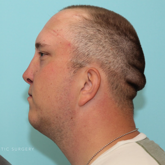 Reconstructive Rhinoplasty with Rib Grafts after 3480814
