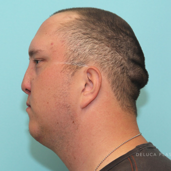 Reconstructive Rhinoplasty with Rib Grafts before 3480814