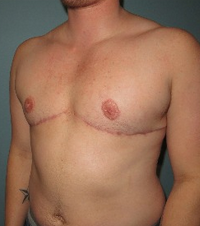 35-44 year old treated with mastectomy (Female to Male "Top" Surgery) after 2109142