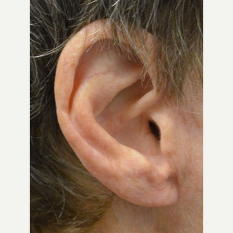 75 and up year old woman treated with Ear Lobe lift Surgery after 3453105