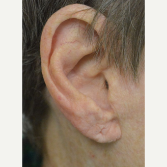 75 and up year old woman treated with Ear Lobe lift Surgery before 3453105
