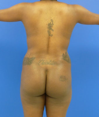 27 y.o. female – Liposuction of abdomen, flanks, and back with fat transfer to buttocks & hips – 1300 cc per side 1143810