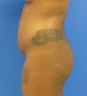 27 y.o. female – Liposuction of abdomen, flanks, and back with fat transfer to buttocks & hips – 1300 cc per side before 1143810