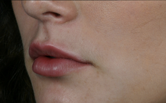Juvederm Ultra Plus after 296320