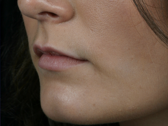 Juvederm Ultra Plus before 296320