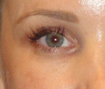 Restylane after 971879