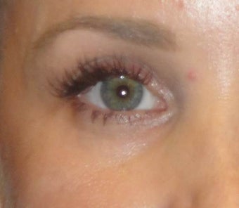 Restylane before 971879
