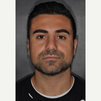 18-24 year old man treated with Rhinoplasty 6 weeks post-op after 3500124