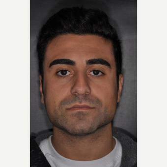 18-24 year old man treated with Rhinoplasty 6 weeks post-op before 3500124
