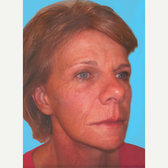 Facelift after 3824852
