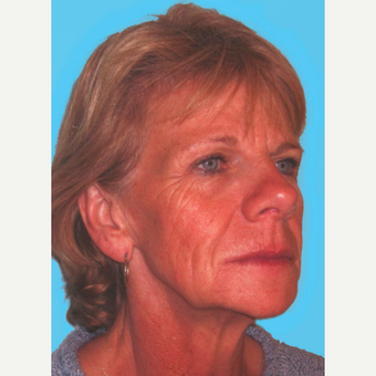 Facelift before 3824852
