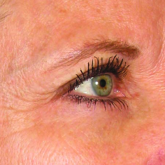 Ultherapy before 1342667