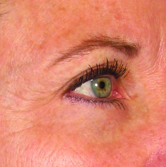 Ultherapy after 1342667