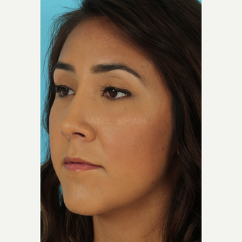 25-34 year old woman treated with Rhinoplasty after 3690859