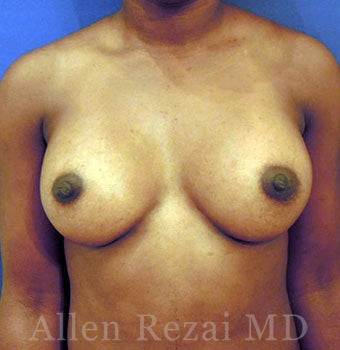 Bilateral Breast Augmentation - Pre- & 4 Years Post-op after 2255567