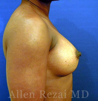 Bilateral Breast Augmentation - Pre- & 4 Years Post-op 2255567