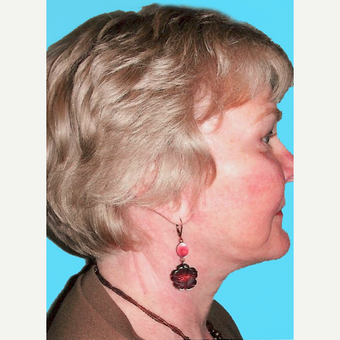 Facelift after 3826888