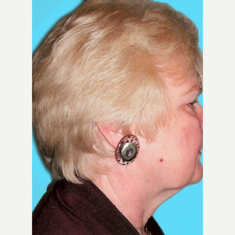 Facelift before 3826888
