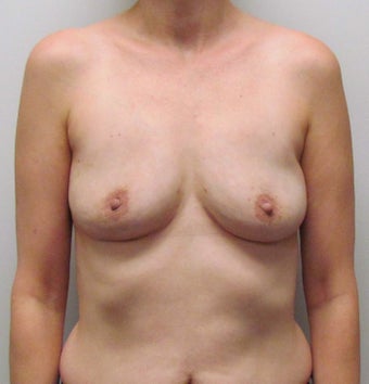 Breast Implant Removal for Implant Rupture and Capsular Contracture after 1445054