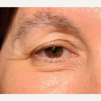 Upper and Lower Eyelids treated w/ Sciton Erbium Resurfacing Laser before 3793597