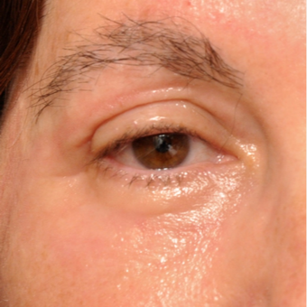 Upper and Lower Eyelids treated w/ Sciton Erbium Resurfacing Laser after 3793597