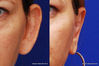 Ear Surgery before 1445750