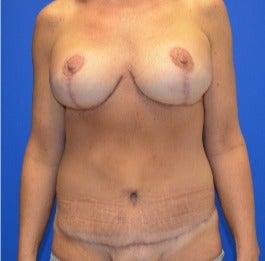 35-44 year old woman treated with Mommy Makeover after 3180073