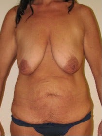 35-44 year old woman treated with Mommy Makeover before 3180073