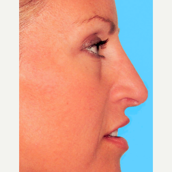 Rhinoplasty after 3814222