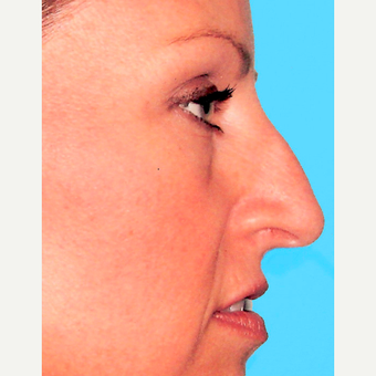 Rhinoplasty before 3814222