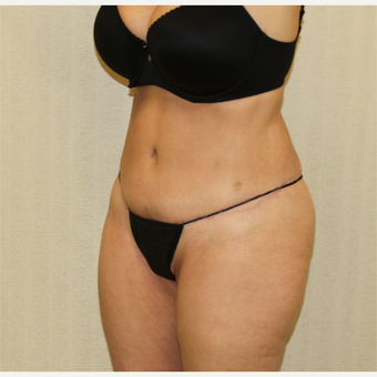 55-64 year old woman treated with Tummy Tuck after 2988704