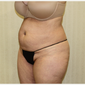 55-64 year old woman treated with Tummy Tuck before 2988704