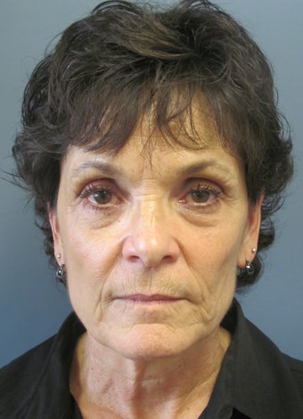 LiteLift™ and Blue Peel on 60-year-old Woman before 413743